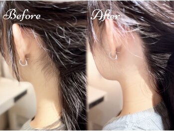 ピミル(PIMIL)/うなじ脱毛