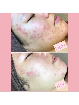 プレジール(Plaisir)/サーマトリックス＆エクソソーム