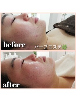 エクラ(eclat)/ハーブエステ