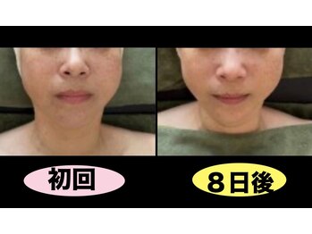 ビーオリビン(B-olivine)/小顔＆リフトアップフェイシャル