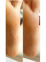 ラ プリュム(La plume)/足裏角質除去