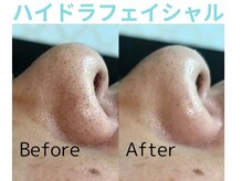 ライズ 岩見沢店(RISE)/ハイドラフェイシャル