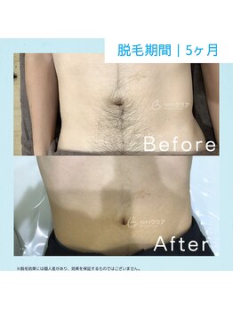 メンズクリア 上水戸ドンキ店/【メンズクリア】お客様の施術例