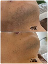 アールセカンド(R.Second)/ヒゲ脱毛