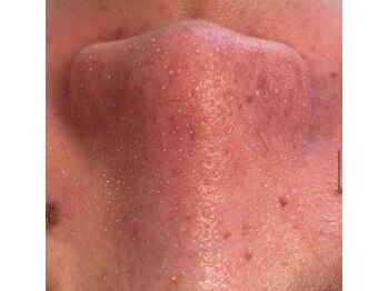 ルチル(Rutile)/韓国式3D毛穴洗浄