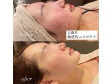 ウー バイ ルーヴェ(ou by Luve)/陶肌トリートメント