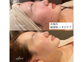 ウー バイ ルーヴェ(ou by Luve)/陶肌トリートメント