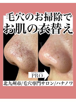 ハナノワ(花のWA)/毛穴図鑑