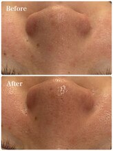 モテ 新宿店(Mote)/ハイドラ毛穴洗浄＋艶肌Wax 新宿