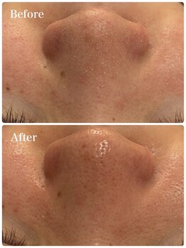 モテ 新宿店(Mote)/ハイドラ毛穴洗浄＋艶肌Wax 新宿