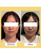 クローバー(clover)/【before/after】施術１回目翌日