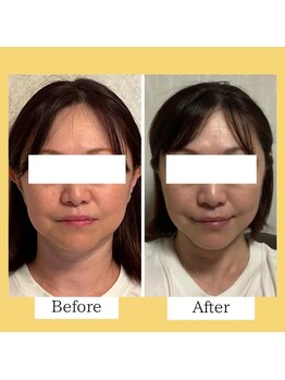 クローバー(clover)/【before/after】施術1回目翌日