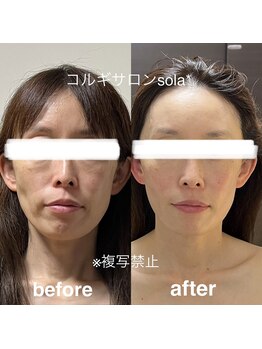 ソラ(sola*)/たるみ引き上げ!小顔コルギ♪