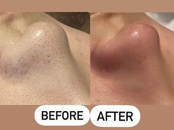 ソーレエルーナ(SOLE e LUNA)/メンズ 毛穴洗浄 専門 新宿