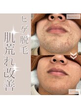 髭ラボ(髭LABO)/ヒゲ脱毛☆肌質改善