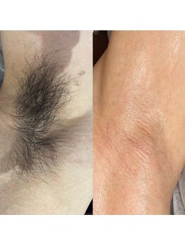 プルメリア(Plumeria)/メンズ脇脱毛