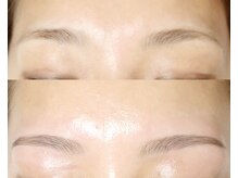 ブルーム(BLOOM)/Hollywood brow lift