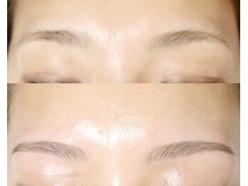 ブルーム(BLOOM)/Hollywood brow lift