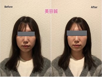 チキバン美容鍼灸整体サロン 心斎橋店/美容鍼（美容針）