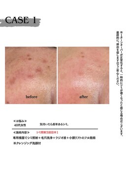 ミウル 天王寺店(miulu)/40代女性/シミ照射3回