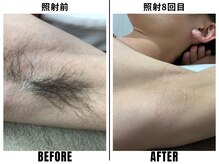 ストック 立花店(STOCK)/【全身】脇脱毛照射前→3回目