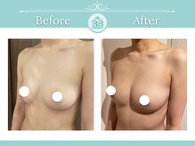 美人バスト アンド ヒップアップ 広島店/バストアップ症例写真