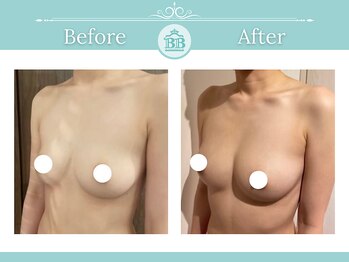 美人バスト アンド ヒップアップ 広島店/バストアップ症例写真