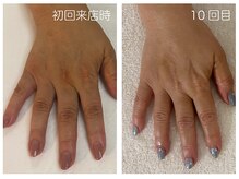 キレイテ 上野店/50代/10回目【ハンドケア上野】