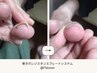 巻き爪開放コース！サロンだからこそ出来る足のお悩みケア！