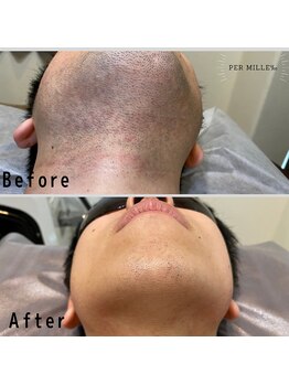 パーミル 弁天町店(per mille‰)/ Before/After