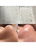 OPEN記念♪【ゴッソリ毛穴角栓★徹底除去】毛穴エクストラクション＋生パック