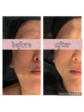 ソイ(soi)/フェイスラインすっきり！