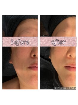 ソイ(soi)/フェイスラインすっきり!