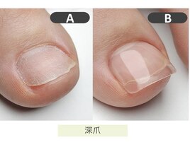 フット深爪矯正(長さだし)赤羽
