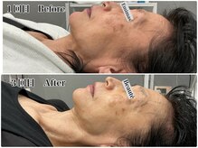 エミマス ボーテ(Emimas Beaute’)/６０代 毛穴洗浄＆幹細胞３回目