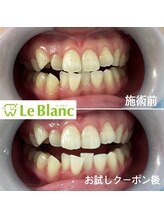 ルブラン 奈良店(Le Blanc)/歯並びが気になる方！