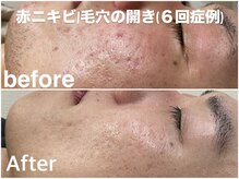 ソフ(soph.)/慢性肌トラブル症例