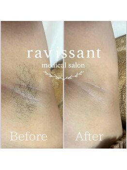 ラヴィソン(ravissant)/ワキ脱毛