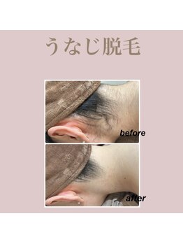 エステティック レイビス 新宿店(RAYVIS)/うなじ脱毛
