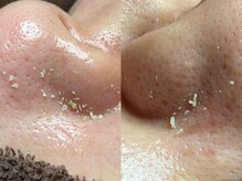 毛穴ケアで毛穴汚れリセット♪