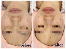 シルク(Cilk)/乾燥肌、毛穴黒ずみに効果絶大！