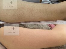 育肌美研 自由が丘サロン/二の腕ケア｜ハーブピーリング