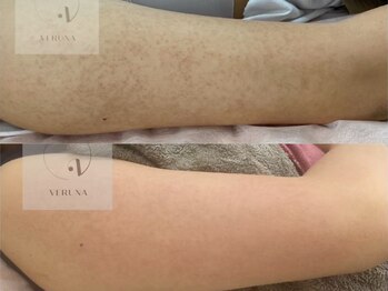 育肌美研 自由が丘サロン/二の腕ケア｜ハーブピーリング