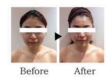 銀座レイア/【小顔矯正ビフォーアフター】