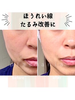 ギフト(gift)/ほうれい線やたるみの改善!