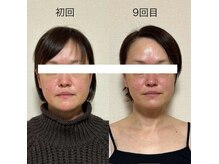 No.3(three)の雰囲気(骨から整えるので立体感のある小顔へ!頬骨位置が上がります♪)