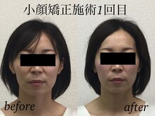 オズ六本木/小顔モニター募集中＠オズ六本木