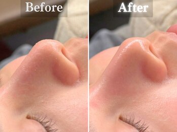 ボーンオム(Born Homme)/毛穴洗浄+美容液導入:20代女性