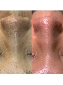 シャルム(CHARME)/ハイドロフェイシャル