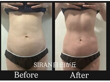 シラン(Siran)/Wラジオ波＋吸引でサイズダウン
